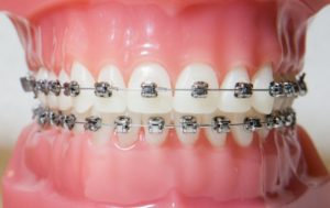 Металлические брекеты: виды и методы установки