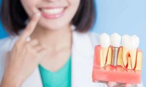 Красивая улыбка доступна каждому: что стоит знать об имплантации зубов