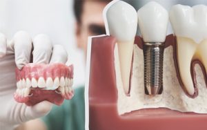 Особенности протезирования зубов. Этапы процесса