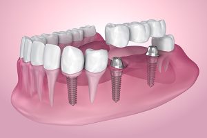 Особенности протезирования зубов. Этапы процесса