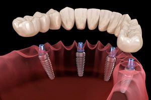 В чем особенности имплантации All-on-4