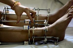 Возможно ли увеличить свой рост с помощью удлинения ног