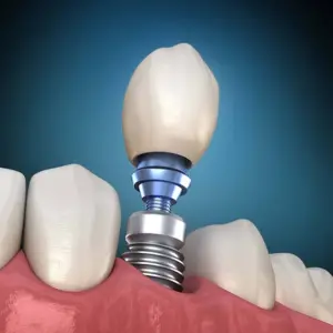 Зубная имплантация: надёжное восстановление утраченных зубов